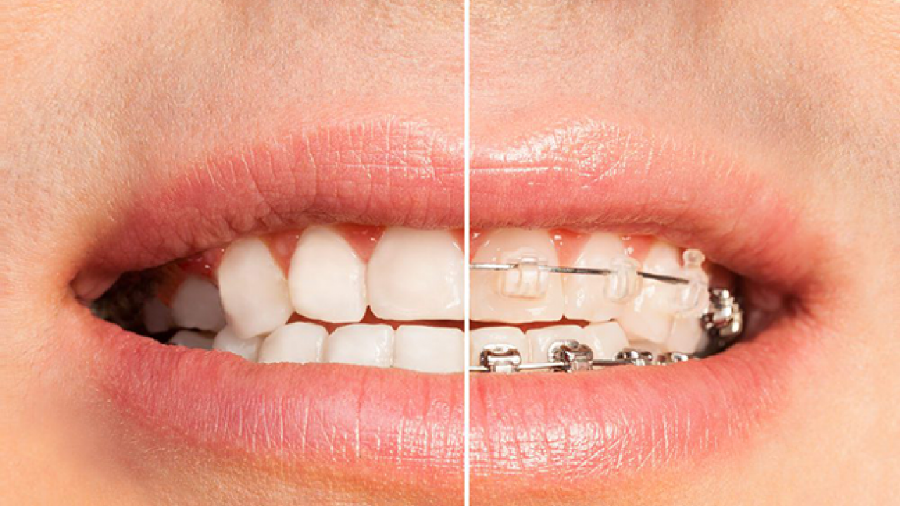 Braces vs Invisalign – City of London – Dental & Skin